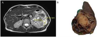 Case report: STRN3-NTRK3 fusion in uterine sarcoma with spleen metastasis: a new variant in the spectrum of NTRK-rearranged tumors